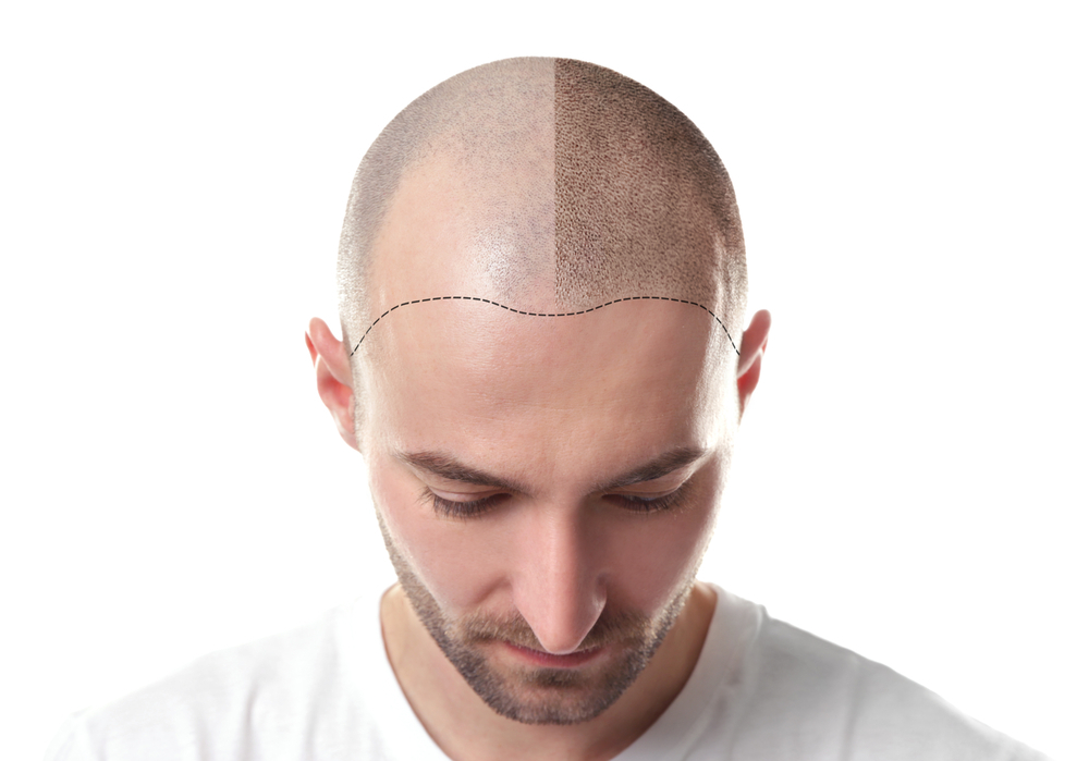 hair transplantation for men