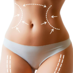 Liposuction